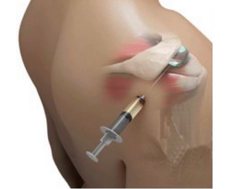 Shoulder Arthritis Injection How to know if you should get an Injection in your Shoulder? | Pontifex ...